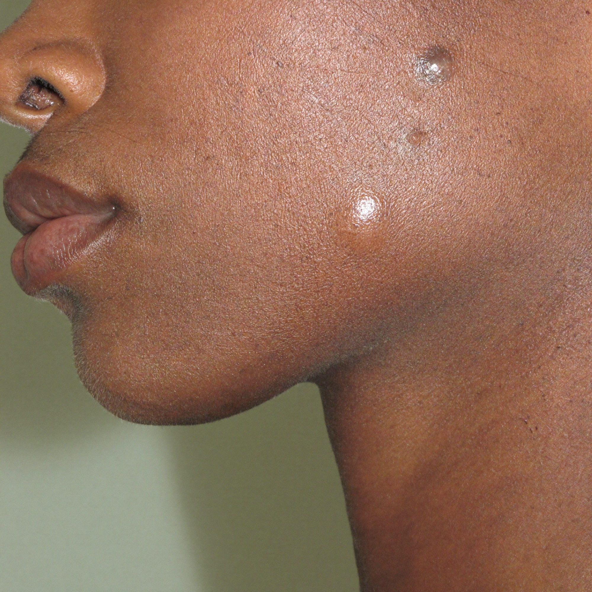 Close-up of a cheek and jaw with active spots and dark marks