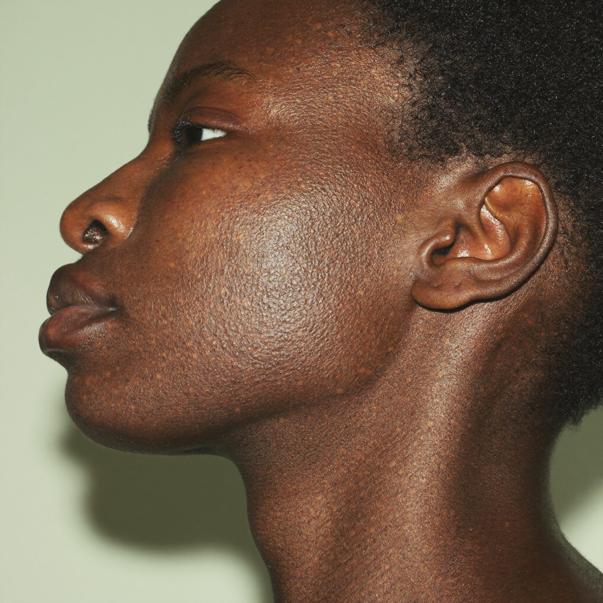 Close-up of deep brown skin, a little dull, with two small dark marks