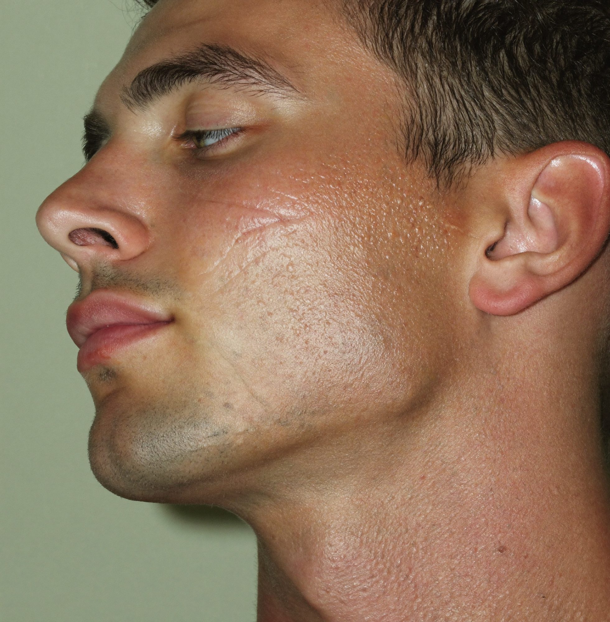 Close-up of a man's cheek with shallow acne scarring